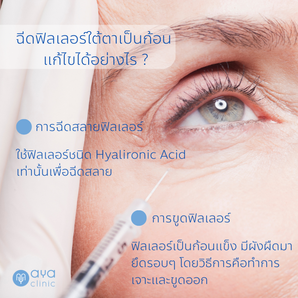 ฟิลเลอร์ใต้ตา