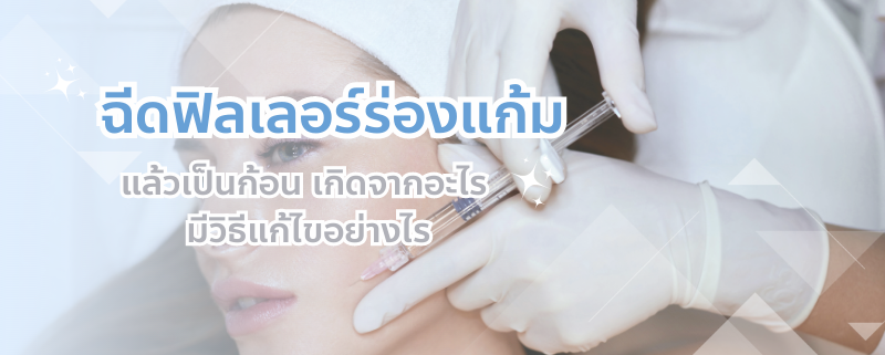 ฟิลเลอร์ร่องแก้มเป็นก้อน