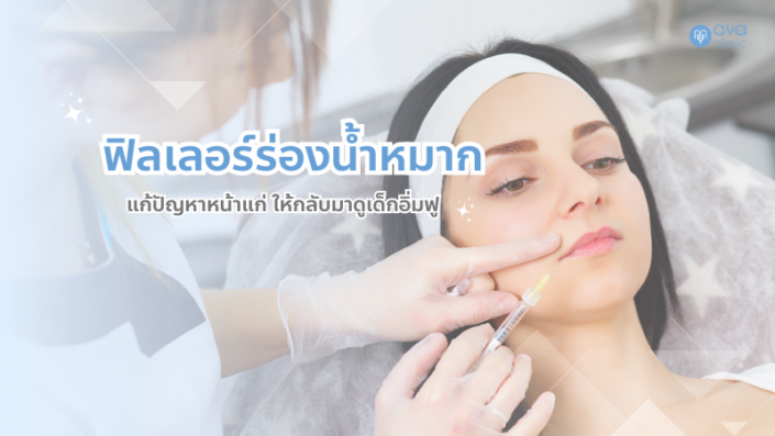 ฟิลเลอร์ร่องน้ำหมาก