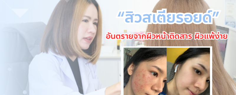 สิว