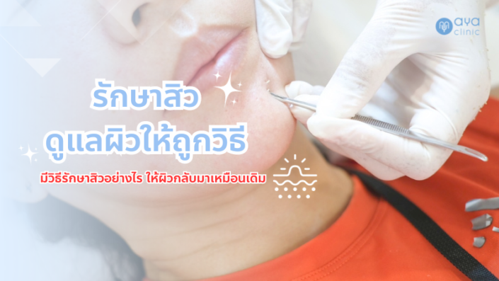 การรักษาสิว