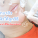 การรักษาสิว