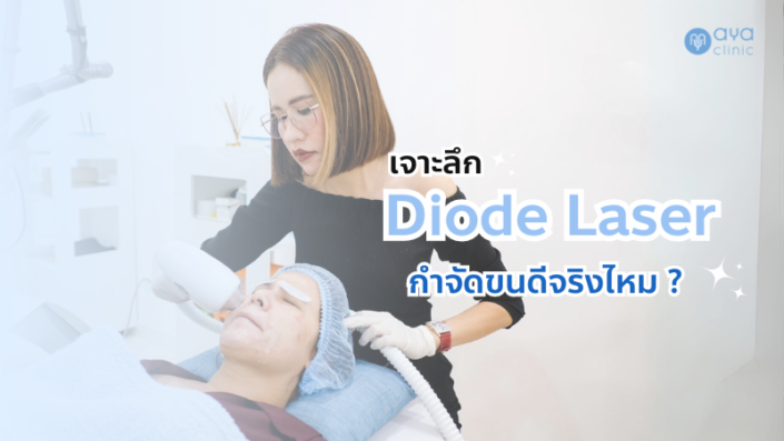 Diode Laser