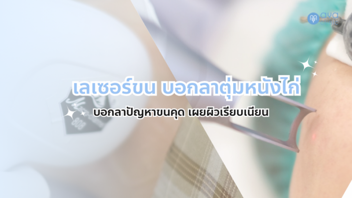 เลเซอร์ขน