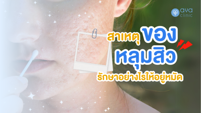 สาเหตุของหลุมสิว