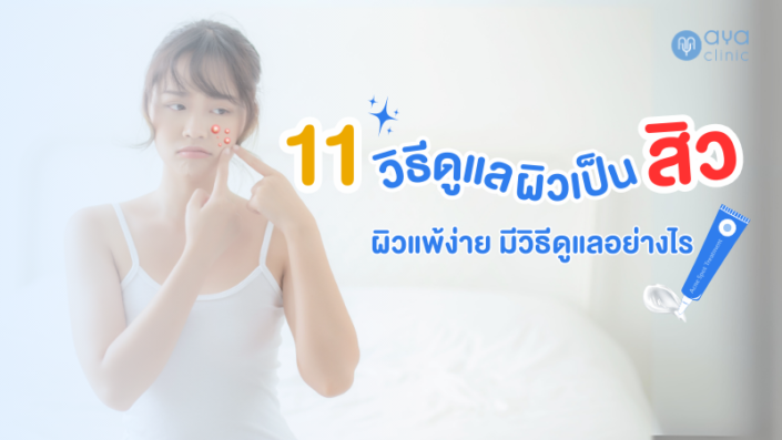 11วิธีดูแลผิวเป็นสิว 11วิธีดูแลผิวเป็นสิว
