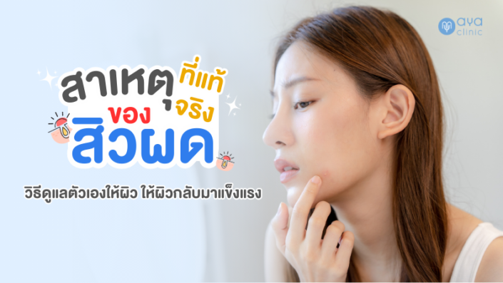 สาเหตุการเกิดสิวผด สาเหตุการเกิดสิวผด