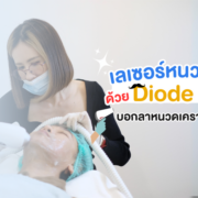 เลเซอร์กำจัดหนวด