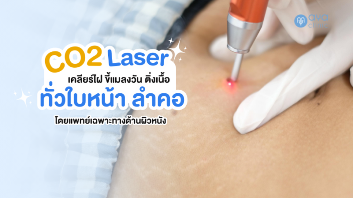 กำจัดไฝ ขี้แมลงวันด้วย CO2 laser กำจัดไฝ ขี้แมลงวันด้วย CO2 laser