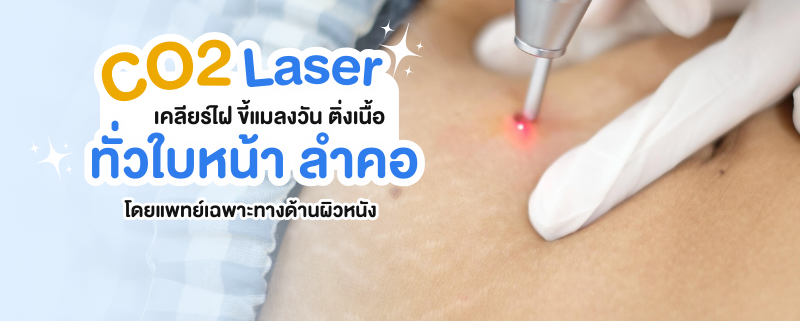 กำจัดไฝ ขี้แมลงวันด้วย CO2 laser