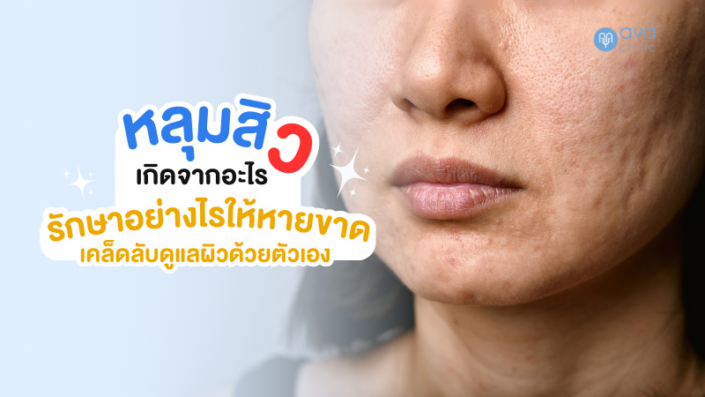 หลุมสิว เกิดจากอะไรรักษาอย่างไร หลุมสิว เกิดจากอะไรรักษาอย่างไร