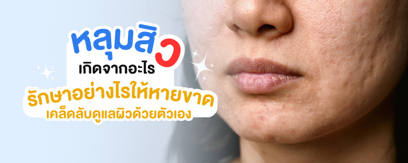 หลุมสิว เกิดจากอะไรรักษาอย่างไร