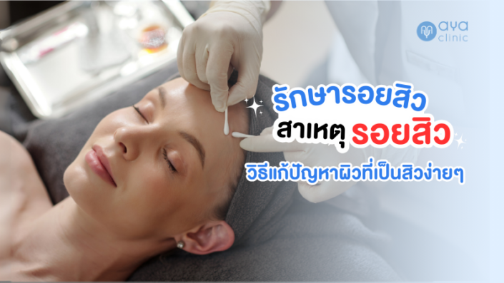 รักษารอยสิว