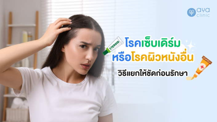 รักษาเซ็บเดิร์ม รักษาเซ็บเดิร์ม