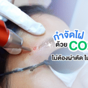 กำจัดไฝด้วยCo2