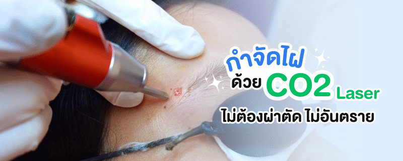 กำจัดไฝด้วยCo2