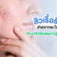 รักษาสิงเรื้อรังโดยแพทย์