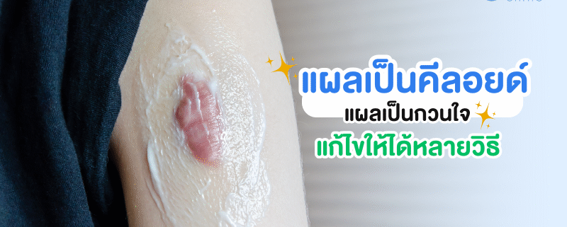 แผลเป็นคีลอยด์