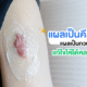 แผลเป็นคีลอยด์