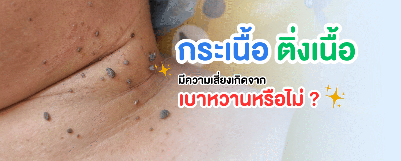กระเนื้อ ติ่งเนื้อ เสี่ยงเบาหวาน