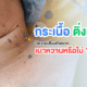 กระเนื้อ ติ่งเนื้อ เสี่ยงเบาหวาน