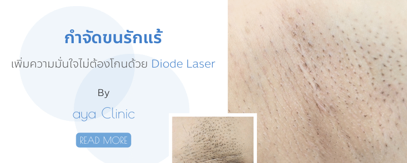 กำจัดขนรักแร้ด้วยDiodeLaser
