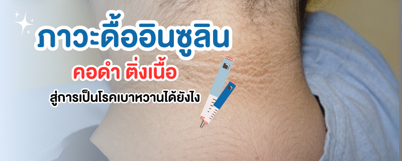 ดื้ออินซูลินเสี่ยงเบาหวาน