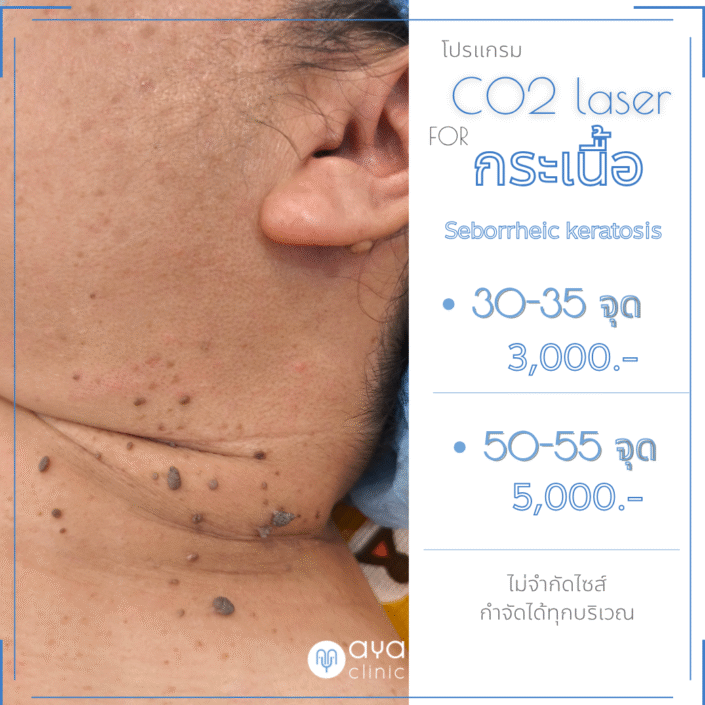 Co2จี้กระเนื้อ