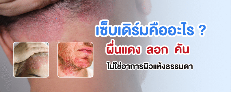 เซ็บเดิร์มคืออะไร