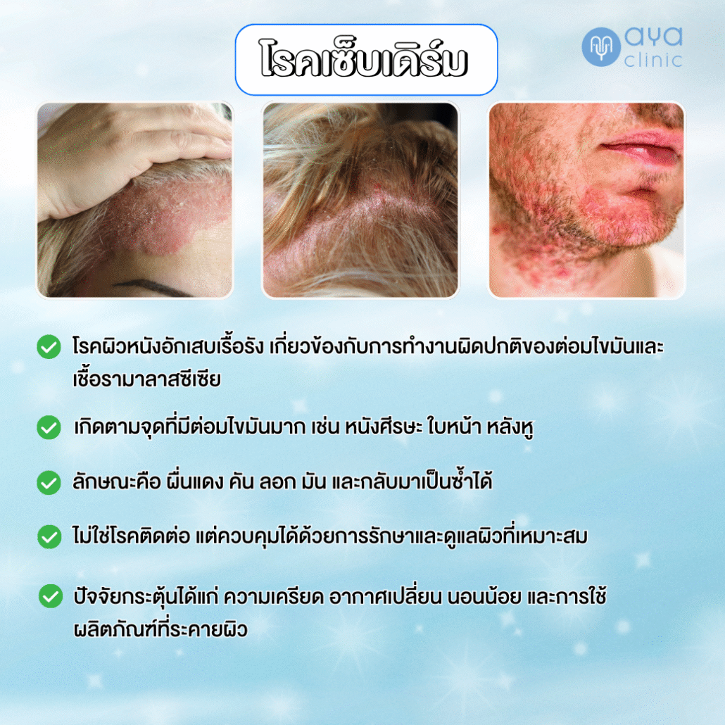 สาเหตุของเซ็บเดิร์ม