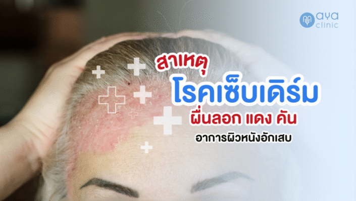สาเหตุของโรคเซ็บเดิร์ม
