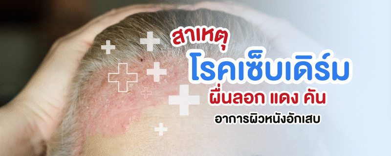 สาเหตุของโรคเซ็บเดิร์ม