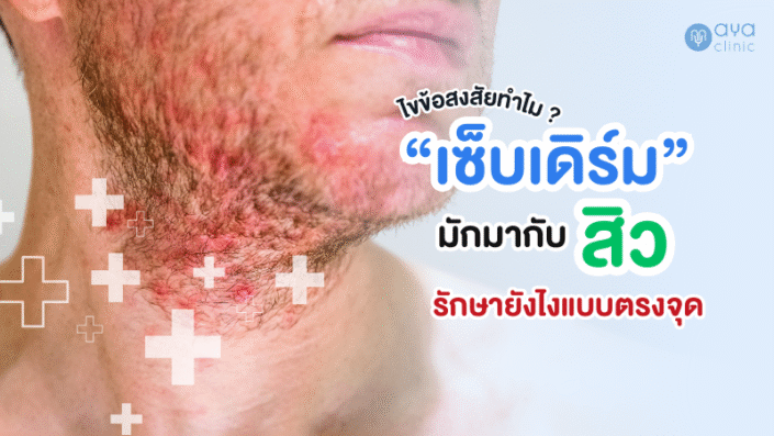เซ็บเดิร์มกับสิว