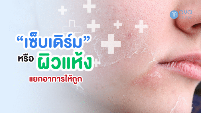 เซ็บเดิร์มกับผิวแห้ง เซ็บเดิร์มกับผิวแห้ง
