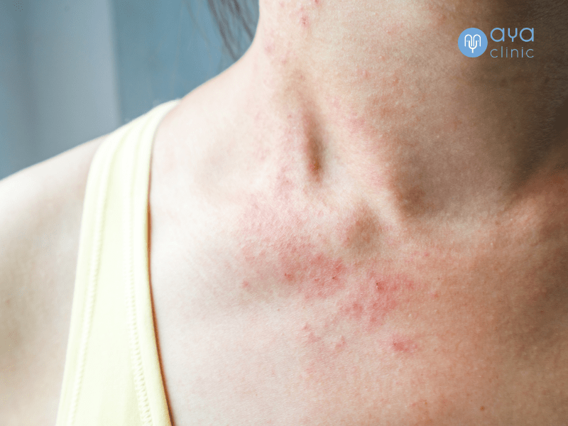 ผื่นแพ้