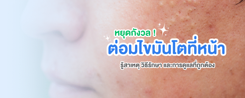 ต่อมไขมันโตที่หน้า