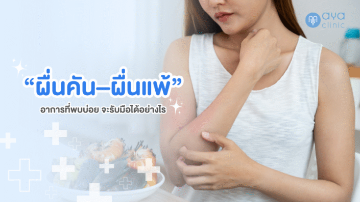 รักษาผื่นคัน ผื่นแพ้
