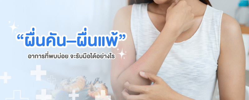 รักษาผื่นคัน ผื่นแพ้