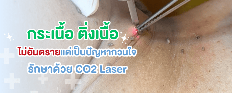 กระเนื้อ ติ่งเนื้อ เกิดจากอะไร