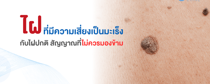 ไฝมะเร็งกับไฝธรรมดาต่างกันอย่างไร