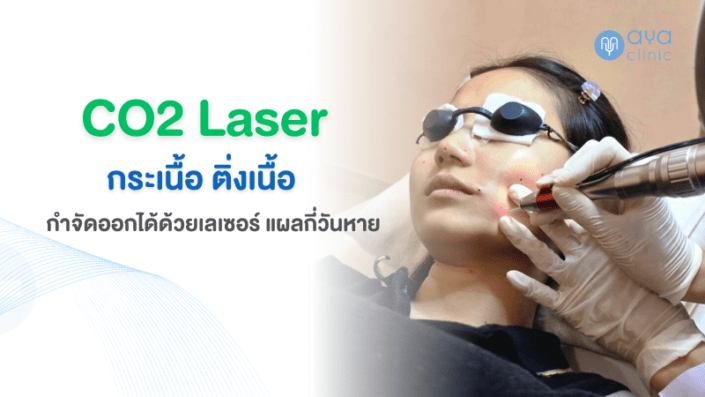 Co2 Laser กำจัดกระเนื้อ ติ่งเนื้อ