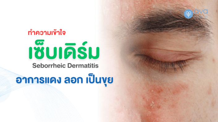 เซ็บเดิร์ม ทำความเข้าใจ