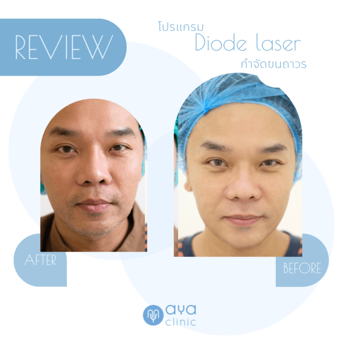 Diode laser กำจัดหนวด