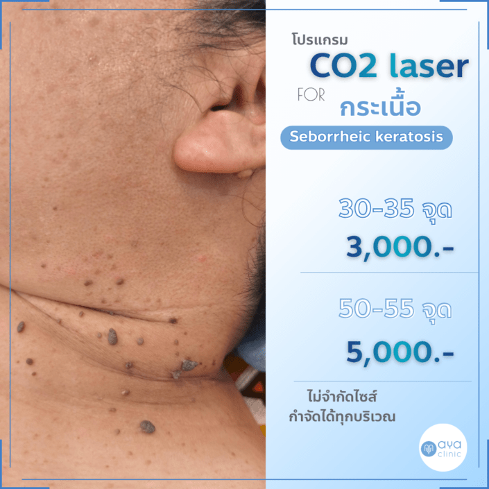Co2 Laser กำจัดกระเนื้อ