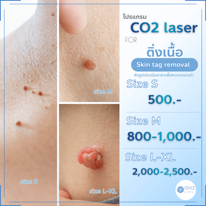 Co2 Laser กำจัดติ่งเนื้อ