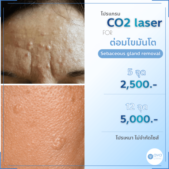 Co2 Laser กำจัดต่อมไขมันโต