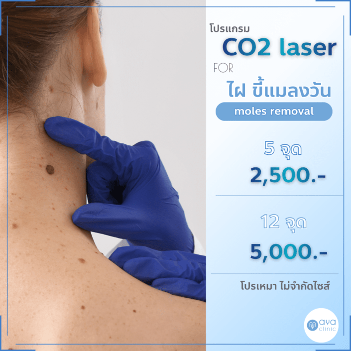 Co2 Laser กำจัดไฝ ขี้แมลงวัน
