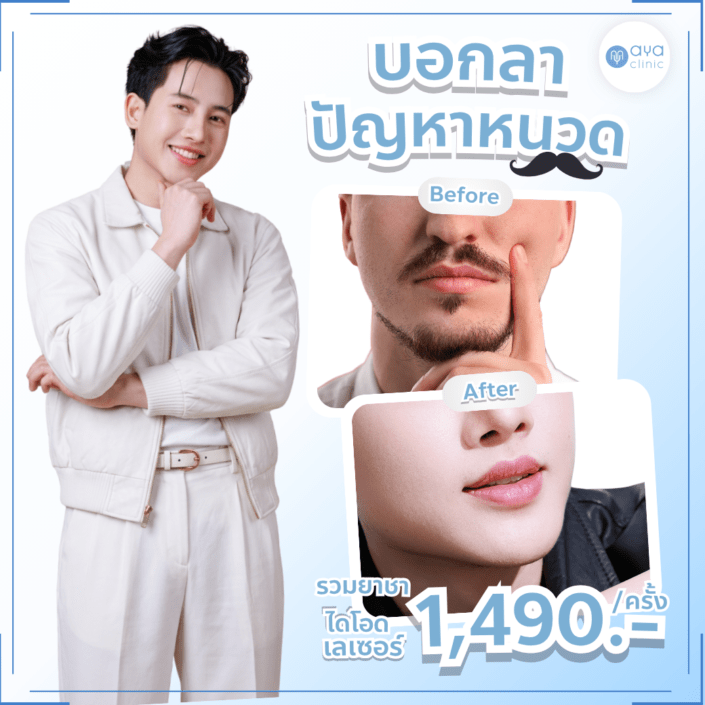 Diode Laserกำจัดหนวดเครา