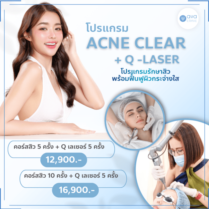 รักษาสิว เลเซอร์ลดรอยสิว