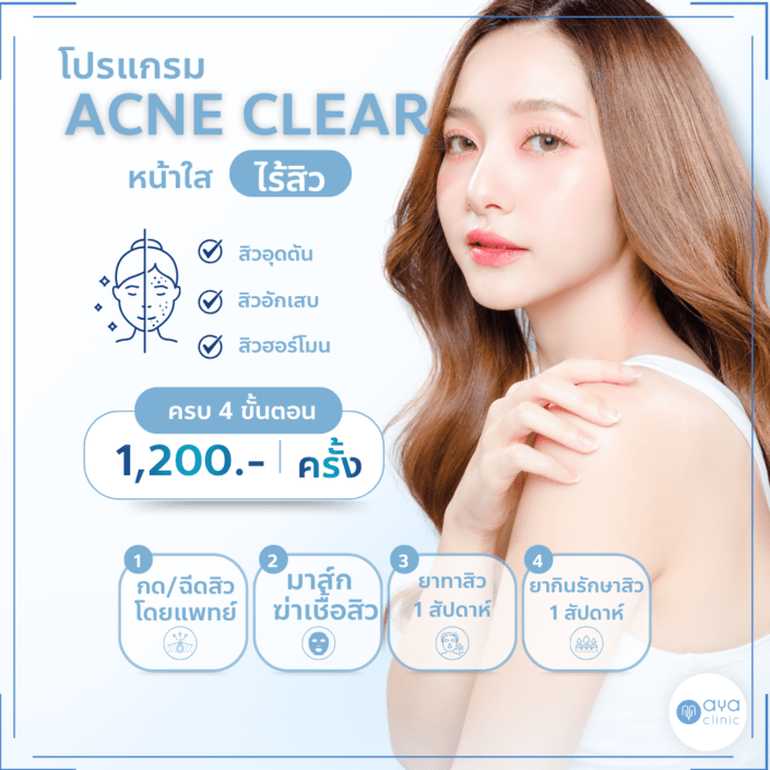 รักษาสิว4ขั้นตอน